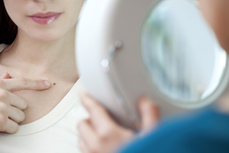 Veränderungen deiner Leberflecke können ein frühzeitiger Warnhinweis für Hautkrebs sein
