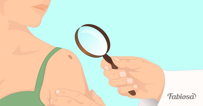 Veränderungen deiner Leberflecke können ein frühzeitiger Warnhinweis für Hautkrebs sein