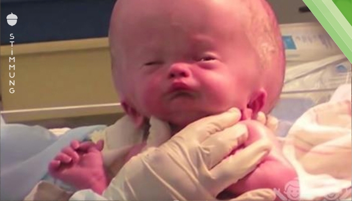 Das Baby wird mit riesigem, geschwollenem Kopf geboren. 20 Monate später können nicht einmal die Ärzte glauben, wie es ihm geht.