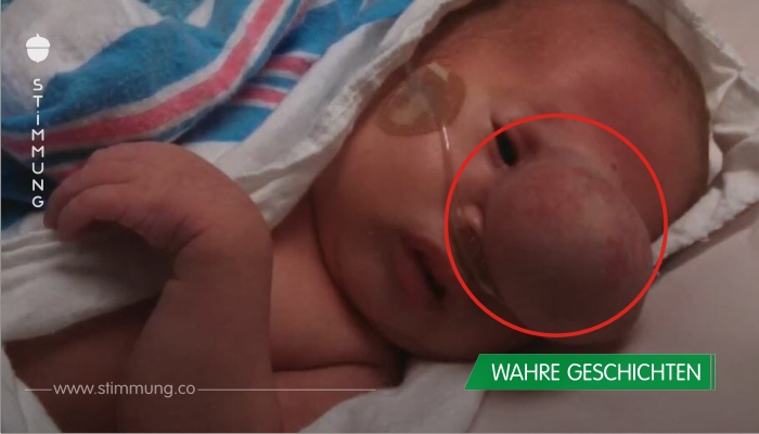 Ärzte entfernen riesigen Sack von Babys Gesicht – was sich darunter versteckt, rührt sie zu Tränen