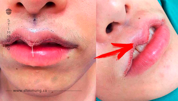 Neuer Schönheitstrend: Lippen-Reduktion.