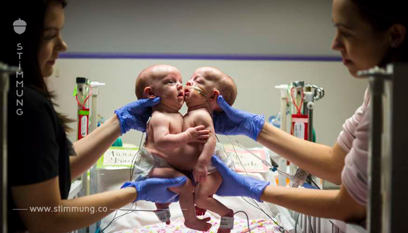 Siamesische Zwillinge nach 7 stündiger Operation getrennt – sehen Sie, wie sie nach der einzigartigen Operation aussehen