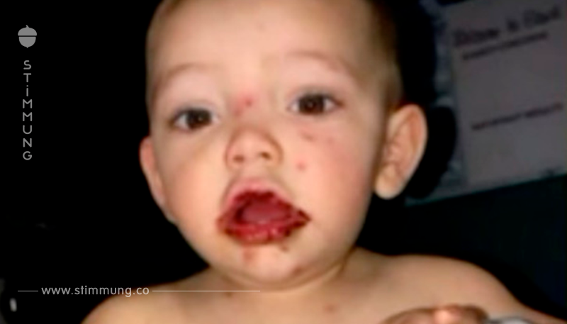 Mutter findet blutige Wunden am Mund ihres Babys – und stößt bald auf die gefährliche Ursache