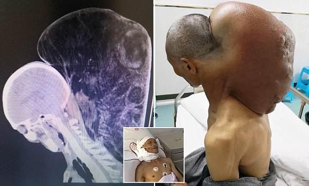 Ein 47 jähriger Chinese  wuchs  einen 15 Kilo Tumor an seinem Hals!