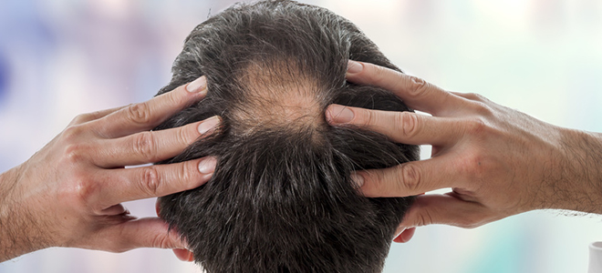 Kreisrunder Haarausfall (Alopecia areata)