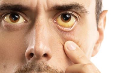 Morbus Meulengracht: Wenn sich Augen und Haut gelb verfärben