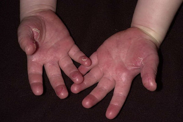 Ein Baby soll wegen einer seltenen Hautkrankheit versteckt werden, durch die sich die Haut 10 Mal schneller als normal schält