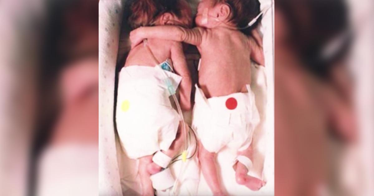Eine Krankenschwester legt ein sterbendes Baby neben ihren Zwilling. Ihr Zwilling umarmt sie und das führt zu einem Wunder