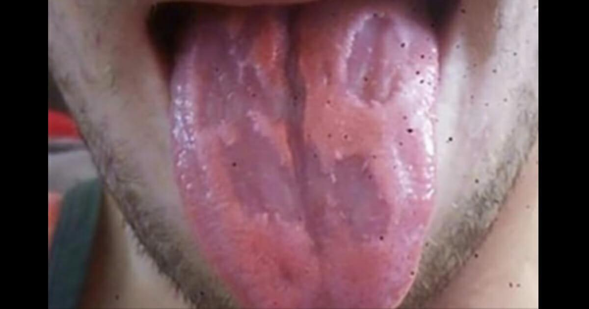 Lehrer zeigt Foto davon, was Energy Drinks mit seiner Zunge gemacht haben