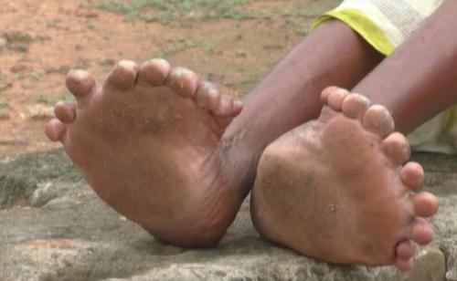 Eine Frau, die mit 19 Zehen und 12 Fingern in Indien geboren wurde, sagt in einem Interview, dass sie nicht rausgehen kann