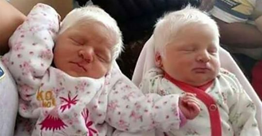 Seltene „Albino Zwillinge“ kommen mit schneeweißen Haaren auf die Welt