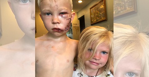 6 Jähriger beschützt kleine Schwester vor Hund – erleidet Verletzungen in Gesicht und wird mit 90 Stichen genäht