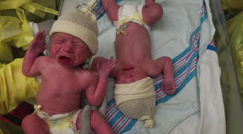 Die ersten Momente von Zwillingsbabys haben alle – auch die Ärzte – in Unglauben versetzt