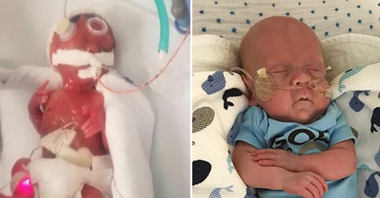 Baby, das in der 22. Woche zur Welt kam, wird von 15 Kliniken abgelehnt – weil er „nicht überleben“ würde