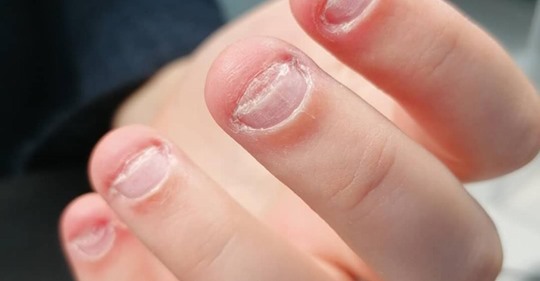 8 Tricks, um mit dem Fingernägel Kauen aufzuhören