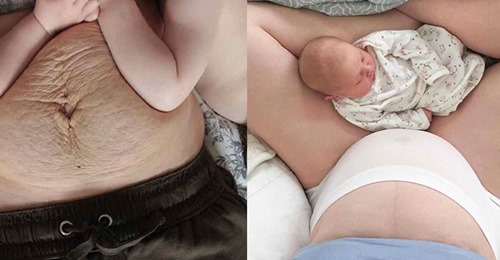 20 Mütter Babybäuche nach der Geburt