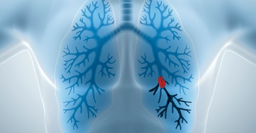 Lungenembolie sofort erkennen und behandeln