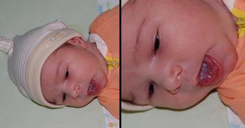 Mundsoor bei Babys: Das hat weißer Zungenbelag zu bedeuten