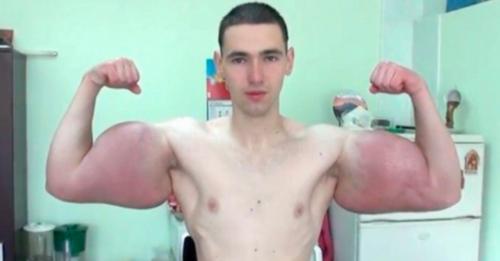 Ärzte entfernen 1,3 Kilo toten Muskel aus Bodybuilder Arm