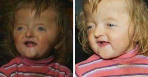 Kindergarten nimmt Zweijährige mit Kopf Deformation nicht auf. Sie könnte 'den anderen Kindern Angst einjagen'