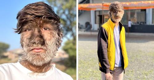 Junger Mann leidet am 'Werwolf Syndrom' und hat ein vollkommen von Haaren bedecktes Gesicht